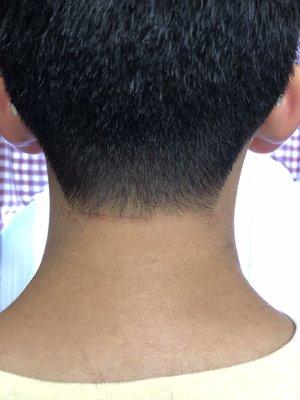 Dull trimmer left painful cut in back of neck