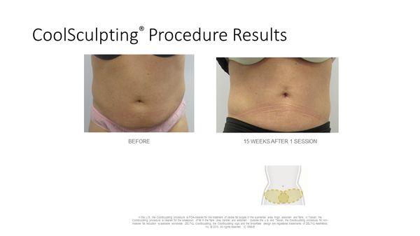 Prestige Medical CoolSculpting patient results