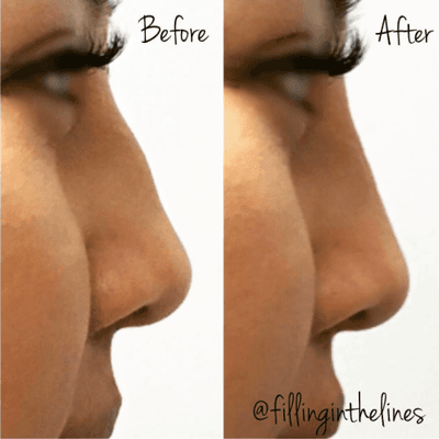 Non Surgical Rhinoplasty using Radiesse