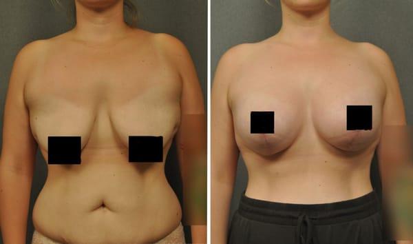 Breast lift #mastopexy with silicone implants.