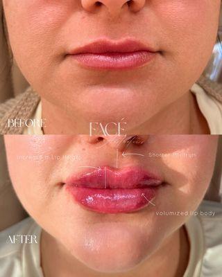 Lip filler after 1 session of 0.8ml by Nurse Pat