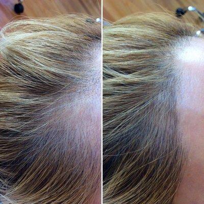 Scalp Microblading can make hair along the hairline and temples look thicker and fuller!