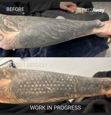 Tatt2Away ,TAtto Removal