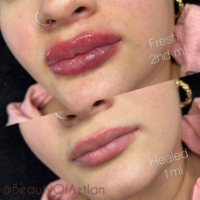 Needle-free lip filler