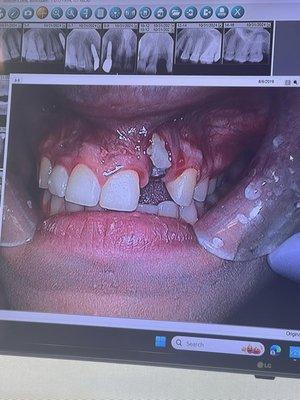 The result of the botched ramus grafting and implant on #10