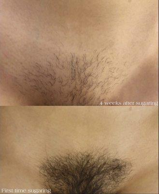 Brazilian Sugaring Hair removal