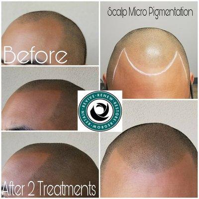 SMP Hairline Restoration