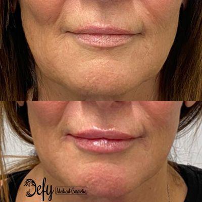 Great lip filler job done by Dr. Quach! What a nice, natural change.