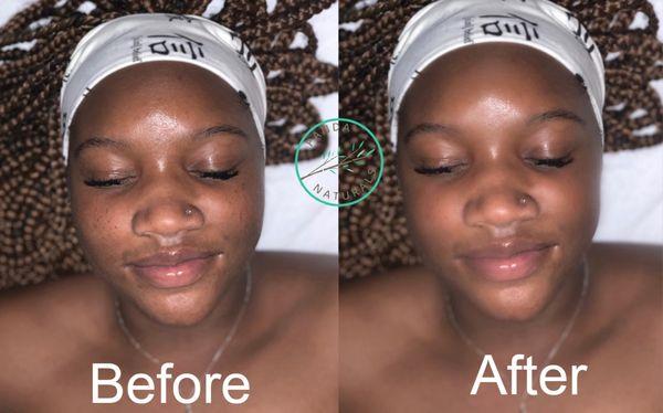 Facial before and after