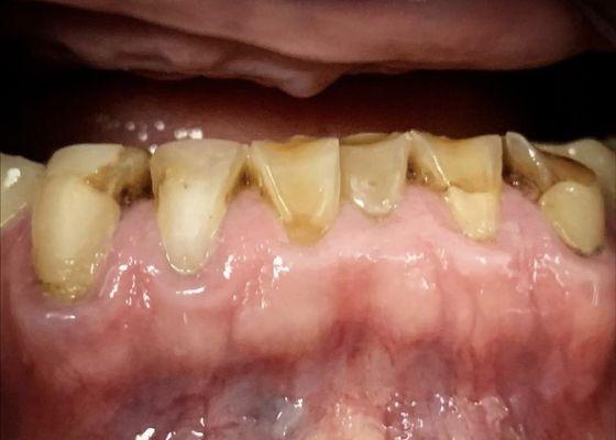 The original condition of the teeth before Dr Yee added Cerec crown