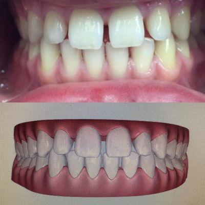 Digital Simulation of patient's teeth before invisalign.