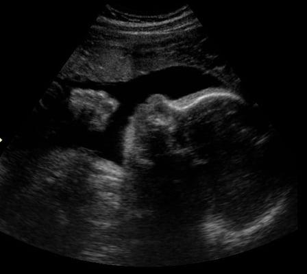 2D ultrasound