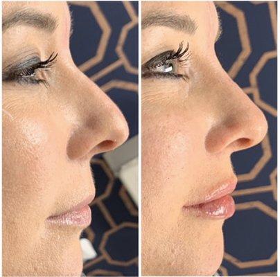 Non surgical rhinoplasty