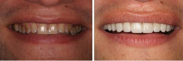 Before and After Smile Makeover