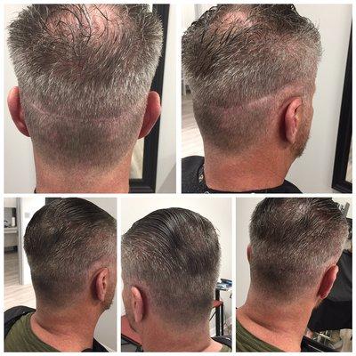 Scalp micropigmentation, the only hair loss solution. Transplant scar camouflaged.