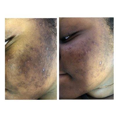 Before and after treatment