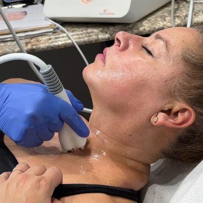 Radiofrequency | Skin Tightening