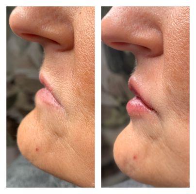 Lip enhancement