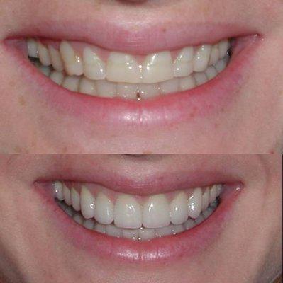 Veneers before and after