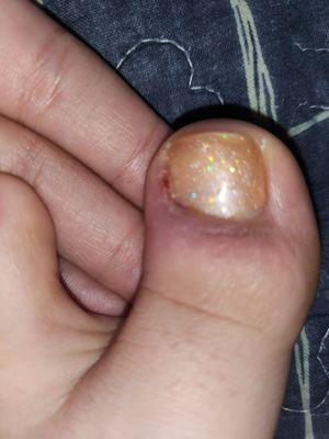 Infected and painful toe due to unclean tools