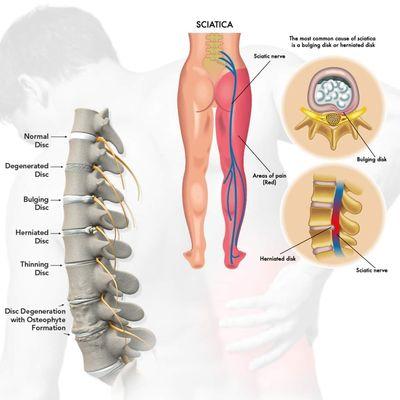 Back pain/Sciatica Relief