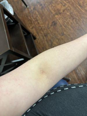 Nurse blood draw, super sweet but couldn't find a vein