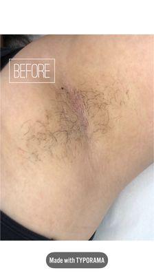 Waxing lasts longer because the hair is removed with the root intact