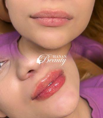 Hyaluron Lip Infusion- needle free lip filler