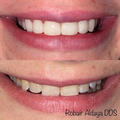 Anterior cosmetic Veneers