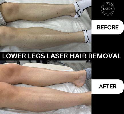 LASER HAIR REMOVAL LOWER LEGS