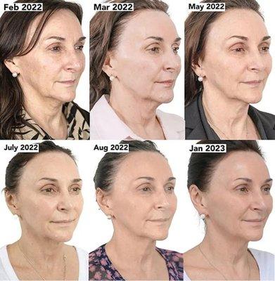 For patients that want to avoid fillers, NeoGen offers an incredible non-surgical face lift solution by supporting elastin & collagen growth