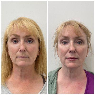 Makeover by New U. Non-invasive face lift with Ultherapy and Thermage