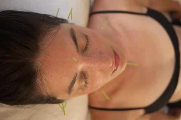 Person relaxing with acupuncture needles in face