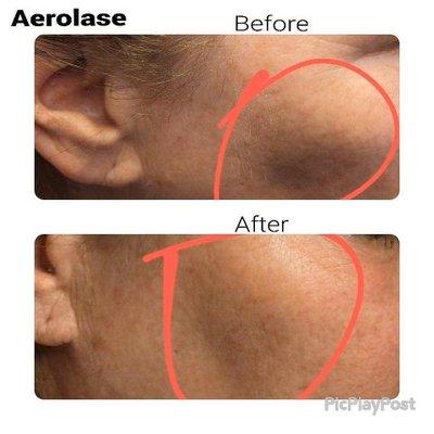 Aerolase before, after photos