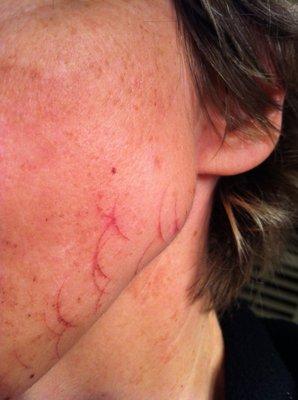 Laser treatment burns.