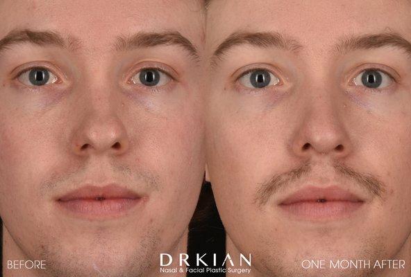 Before & After Septorhinoplasty, performed by Facial Plastic Surgeon Dr. Kian Karimi at Rejuva Medical Aesthetics in Los Angeles, CA.