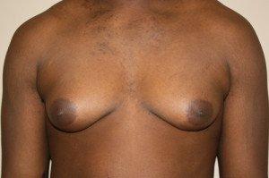 BEFORE: 18 yo male 1 month after chest liposuction with excision