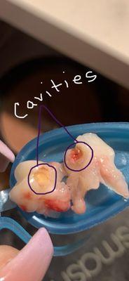 Teeth immediately after extraction after years of regular exams at SFD. Most recent being February 2020.