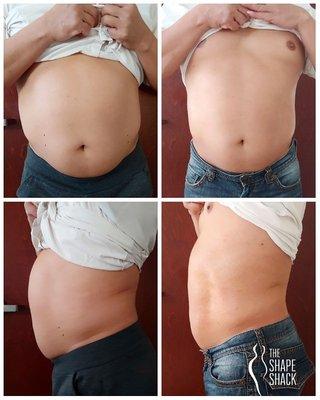 2 full treatments (90 min) and 4 mini liposculpt sessions (20 min)