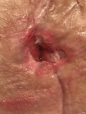 Second open wound that also took two months to close