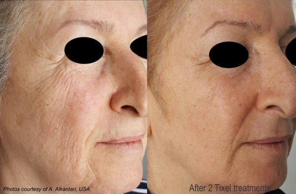 Tixel Treatment Face Wrinkles & Crows Feet in Scottsdale