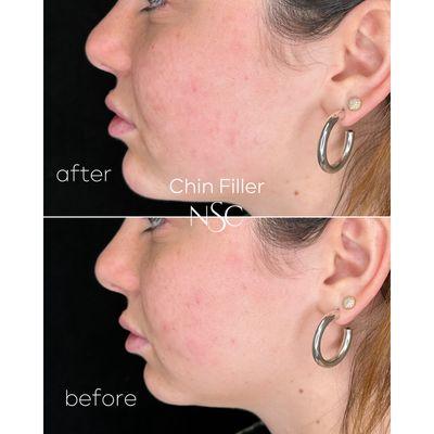 Enhance your profile with chin filler. Achieve a balanced, defined chin for a more sculpted appearance.