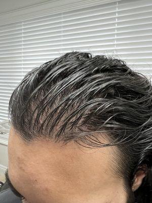 Full scalp prp