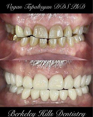 Full Mouth Rehabilitation in just 2 visits