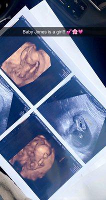 Babyview 3D/4D Ultrasounds