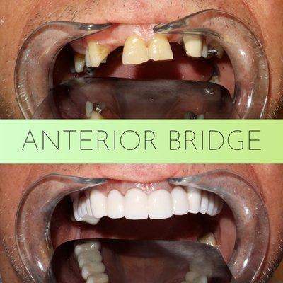 Anterior Bridge