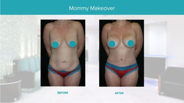 Real Results Before & After-Mommy Makeover