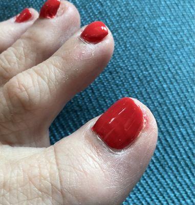 Cut on large toe and very dry cuticle.