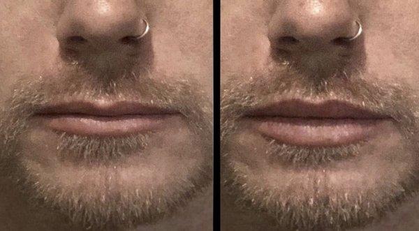 Lip filler on a male patient