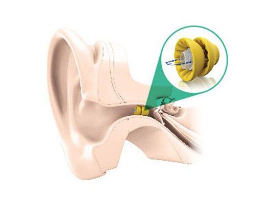 Golden Gate Hearing Services: Lyric® is a deep insertion extended-wear device that is worn 24 hrs day for up to 3 months at a time.